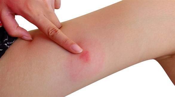 تدابير-لمواجهة-لدغات-البعوض